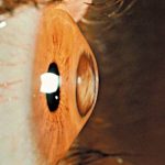 Keratoconus Cross-Linking: Complete Patient Guide