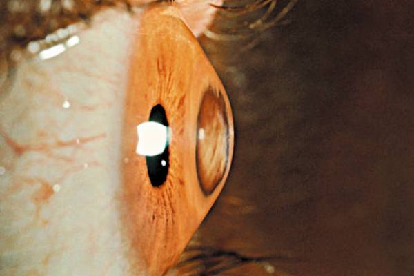 Keratoconus Cross-Linking: Complete Patient Guide